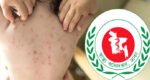 হামের উপসর্গে আরও ৩ মৃত্যু, মোট ১০৮৪