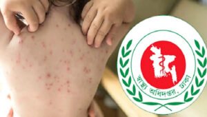 হামের উপসর্গে আরও ৩ মৃত্যু, মোট ১০৮৪